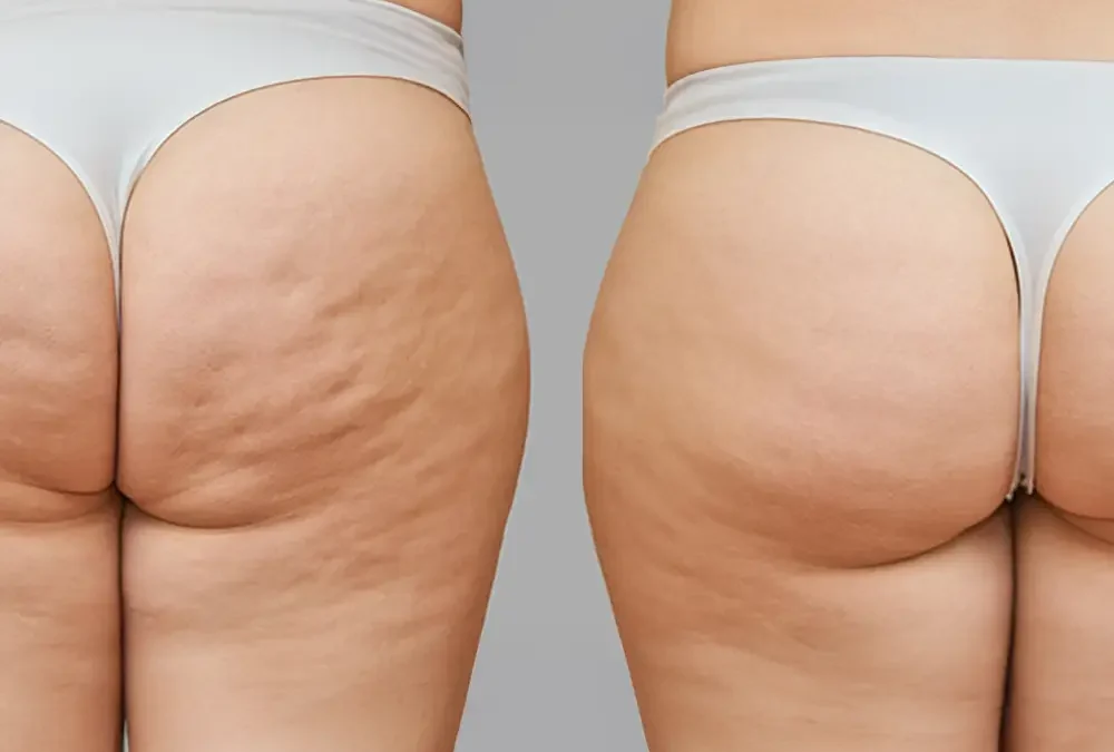 City life Institute - Adiposità vs Cellulite
