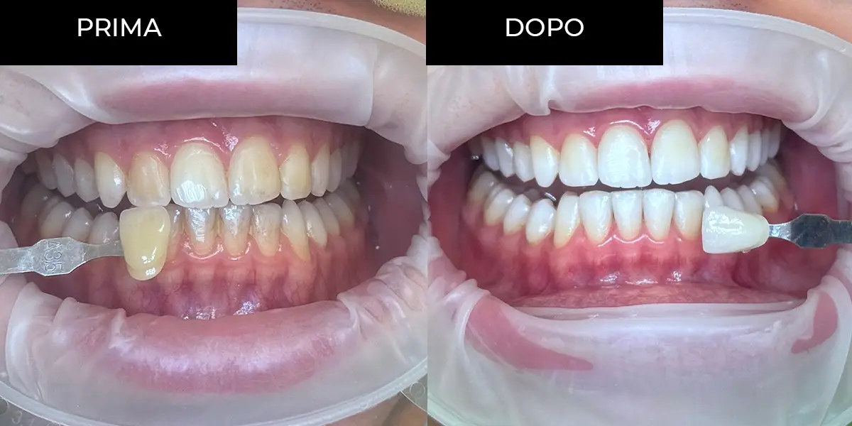 Clinical case - Teeth whitening