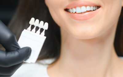 Faccette dentali: cosa sono e quando funzionano davvero