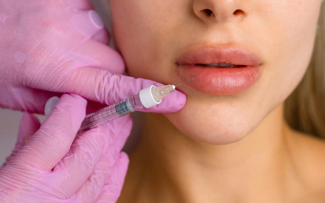 mani medico iniettano filler labbra acido ialuronico